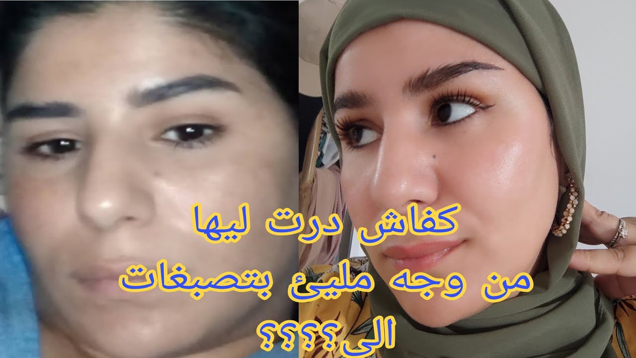 كيف أنقذت بشرتي بالصور/ أساسيات استعملتها و غيرت بشرتي/نصيحة من وحدة قضت على 70 من التصبغات