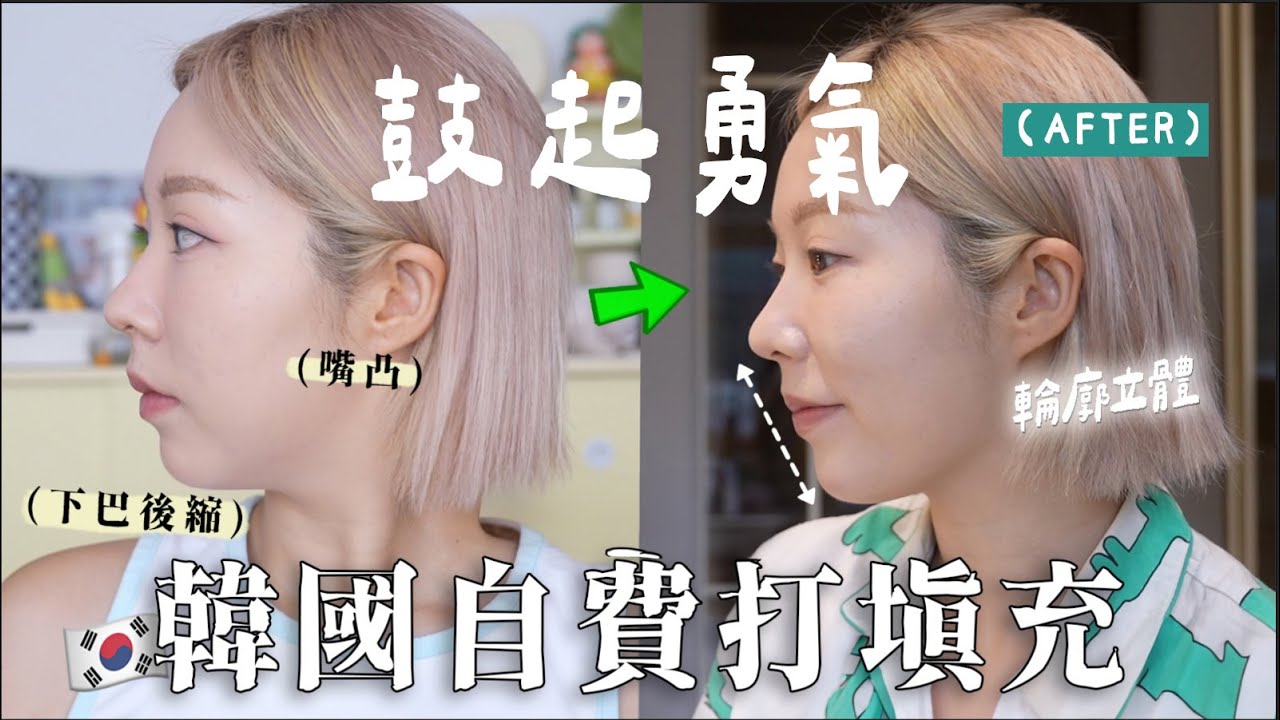 居韓至今最滿意的填充！下巴後縮+淚溝+八字紋(全自費!) 解決自己多年來最糾結的部位⋯才5千元!!!???