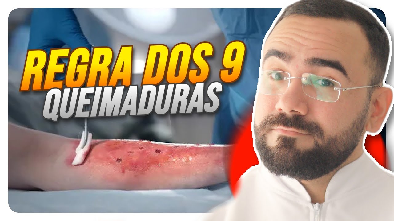 🔥REGRA DOS 09 (QUEIMADURAS) - REGRA DE WALLACE (ATUALIZADO)