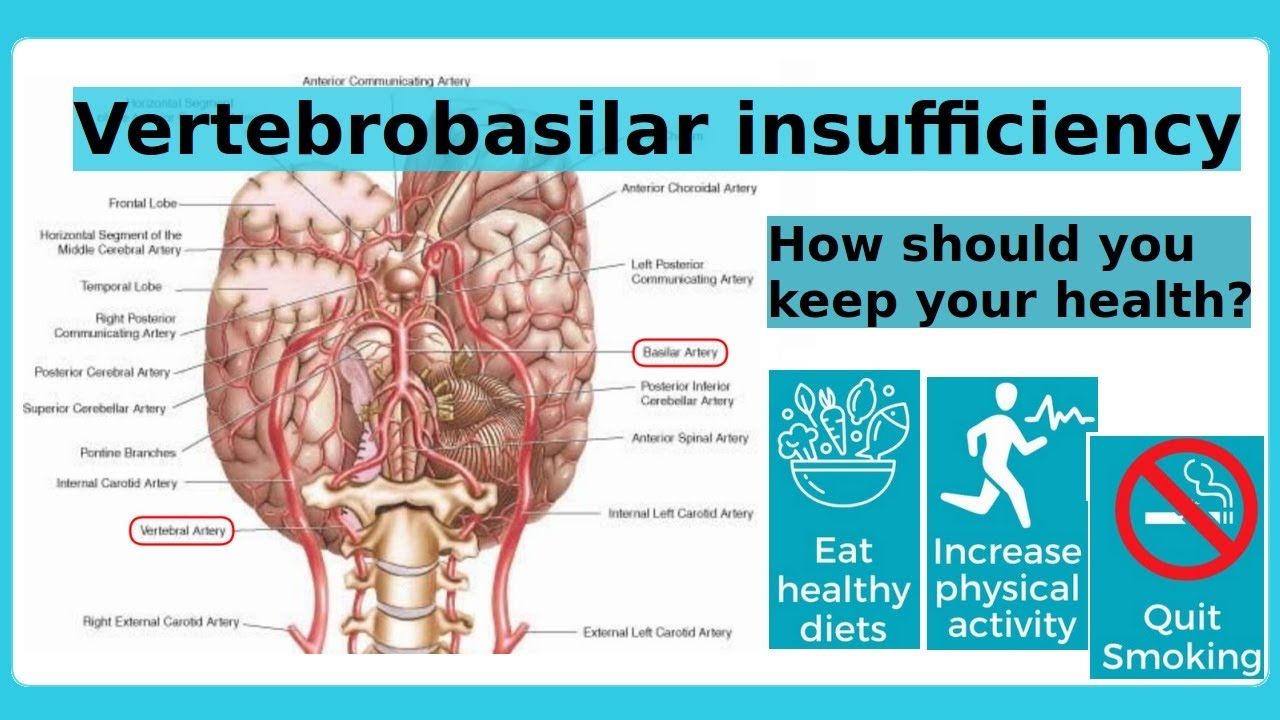 vertebrobasilar insufficiency