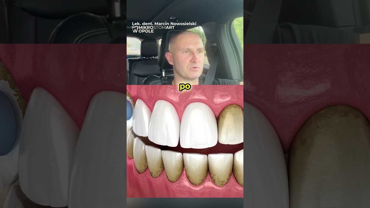 KAMIEŃ NA ZĘBACH😱 (Niedawno Usunięty A Wr&oacute;cił 😳)