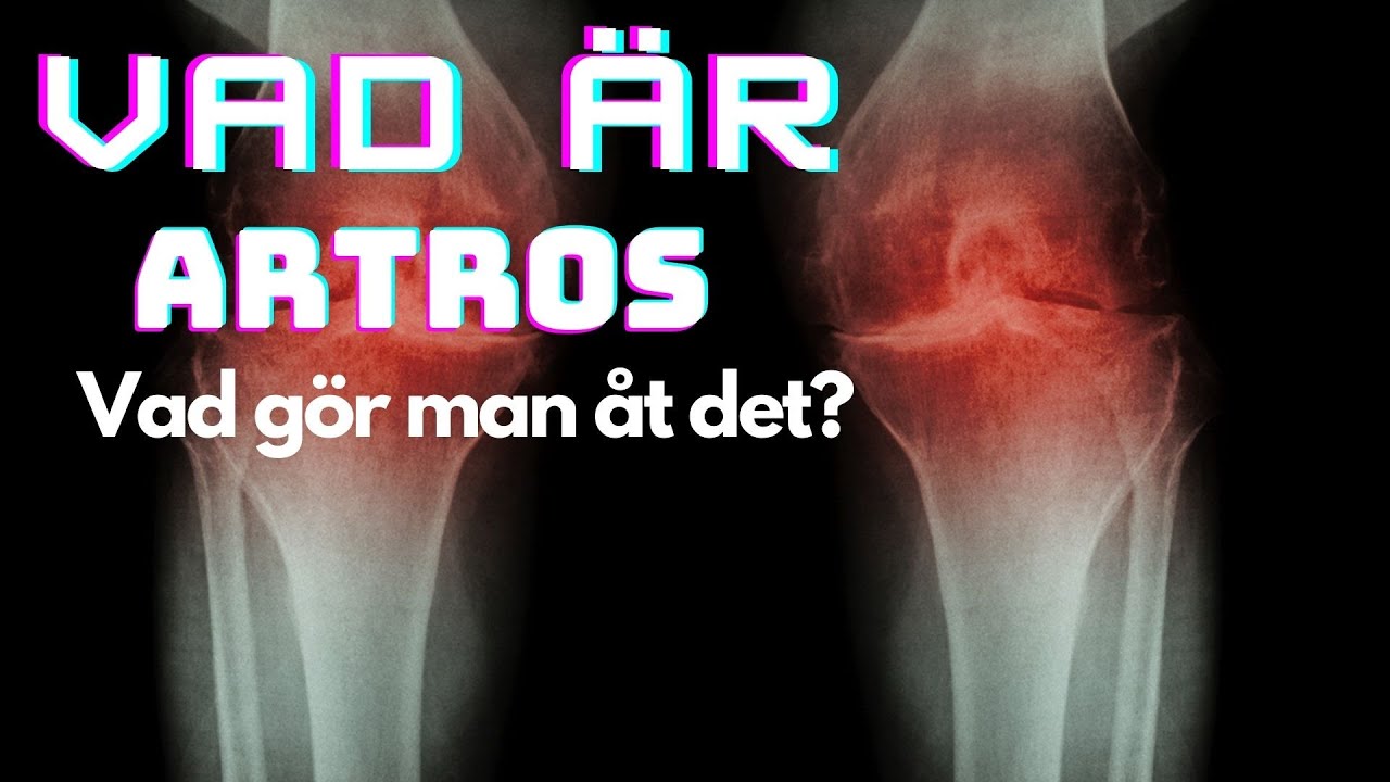 Vad är artros och vad gör man åt det