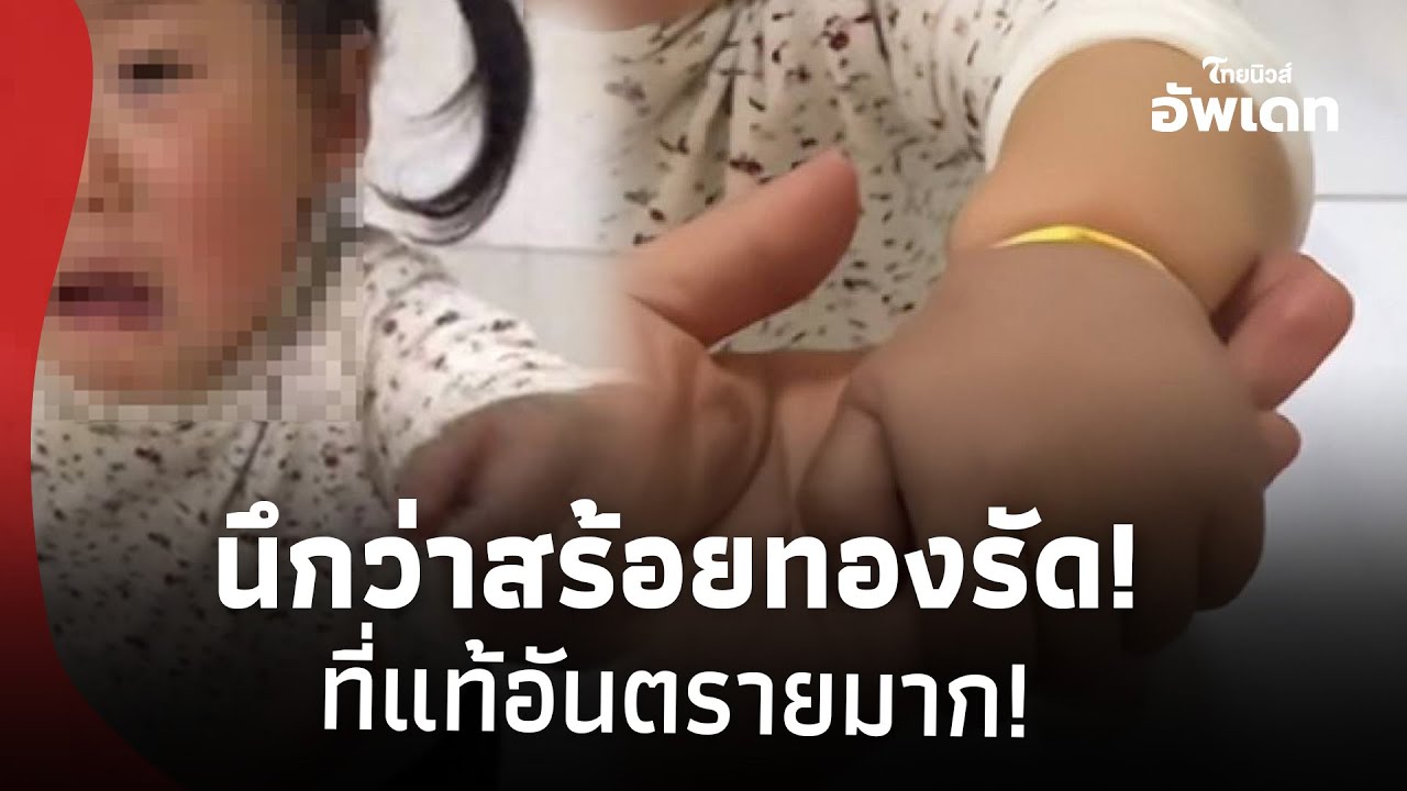 แม่ตกใจ ลูกร้องเจ็บข้อมือ นึกว่าสร้อยทองรัด ก่อนซูมดูยิ่งช็อก ที่แท้อันตรายมาก!  42-SS