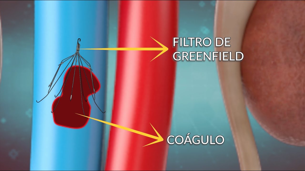 Dr. Anton Meneses - Trombosis Venosa Profunda