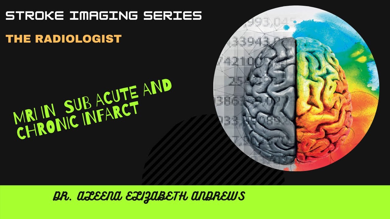 #Stroke_Imaging_Series  MRI subacute and chronic infarct  (Lecture 5)