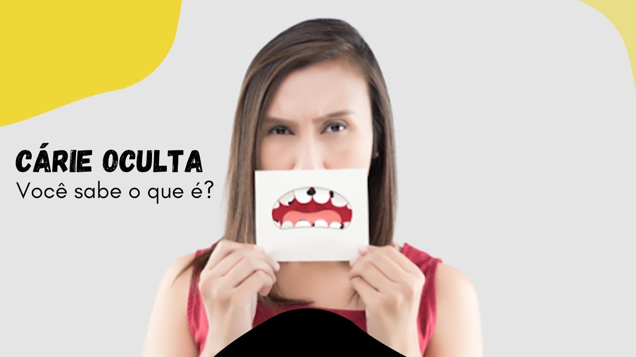 Você sabe o que é cárie oculta? 🤔😷