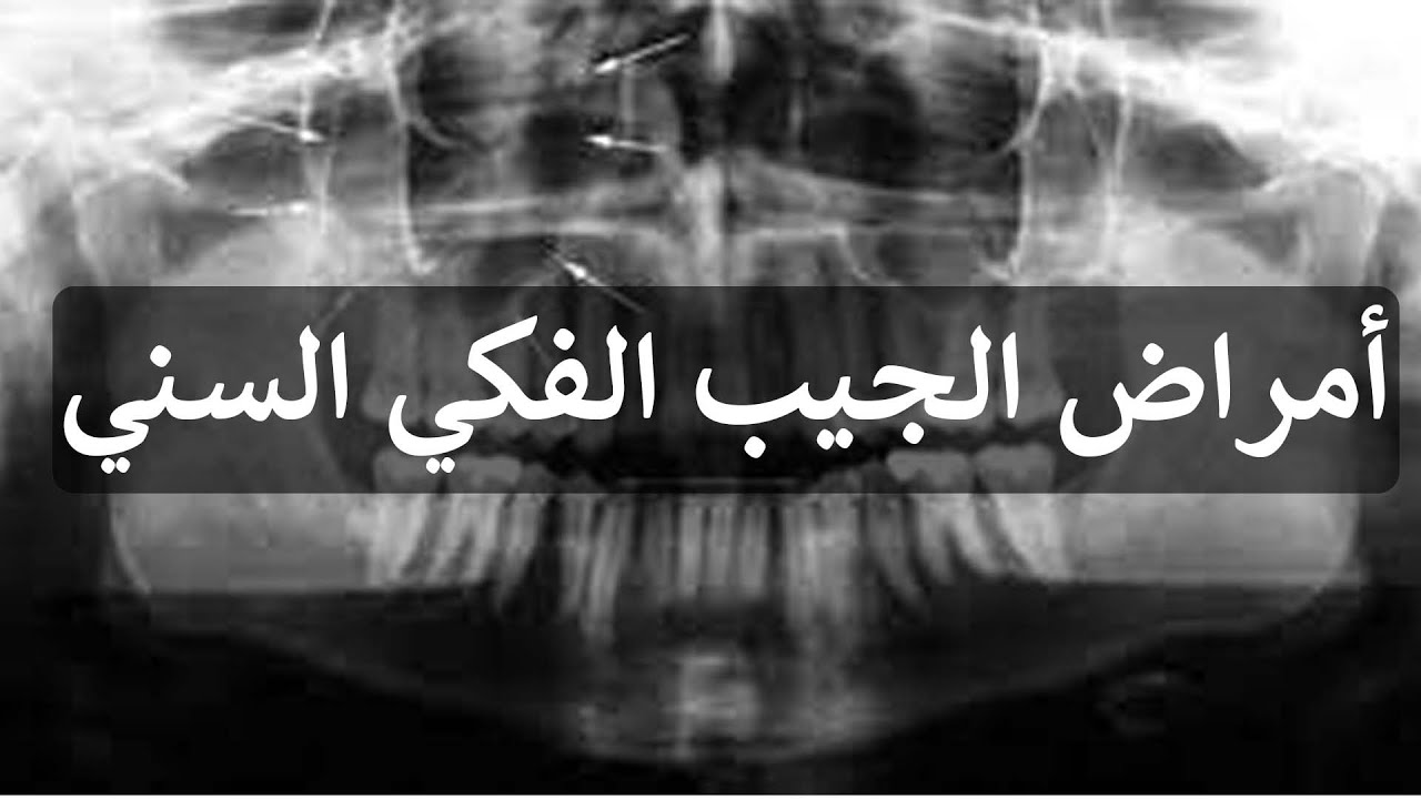 أمراض الجيب الفكي السني مع الدكتور قاسم الهيجاني