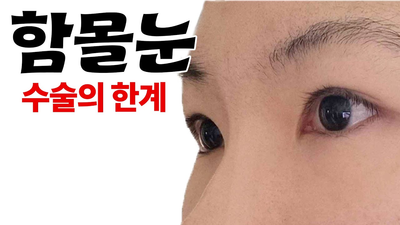 죄송합니다. 함몰눈이기에 안 됩니다.