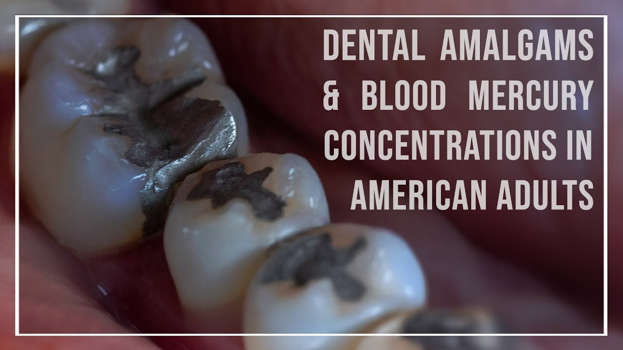 Mercury Dental Fillings Raise Blood Mercury to Dangerous Levels in 100+ Million Americans!