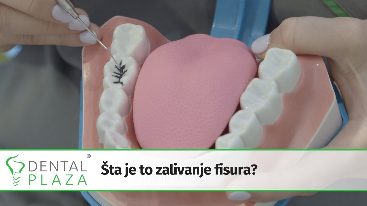 Šta je to zalivanje fisura?