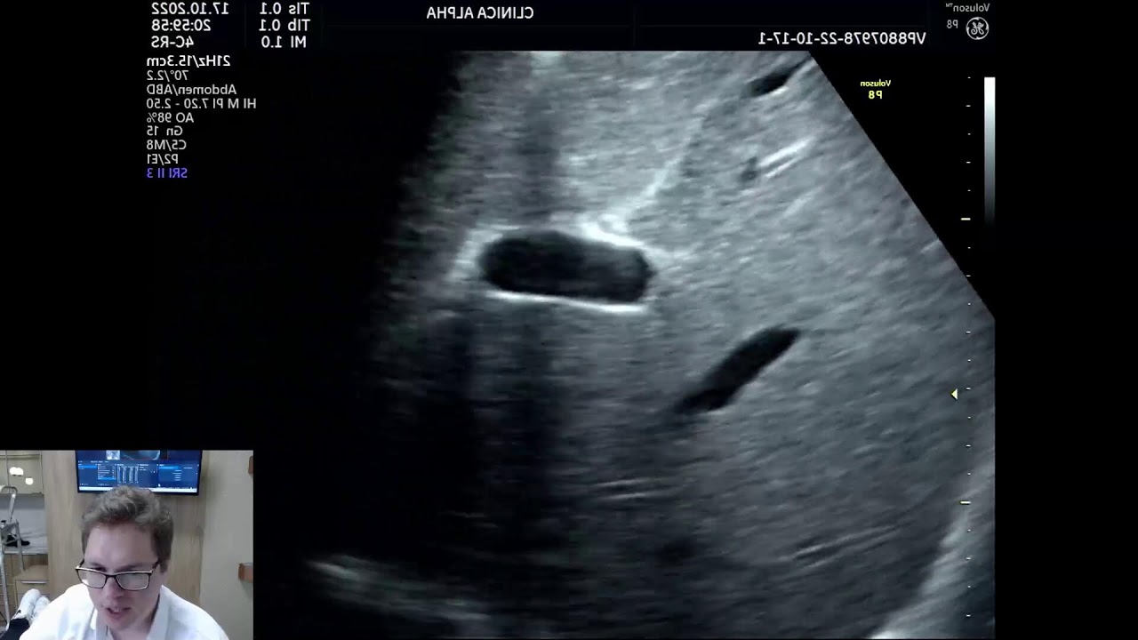 COMO FAZER ULTRASSOM DE ABDOME TOTAL COM DOPPLER?