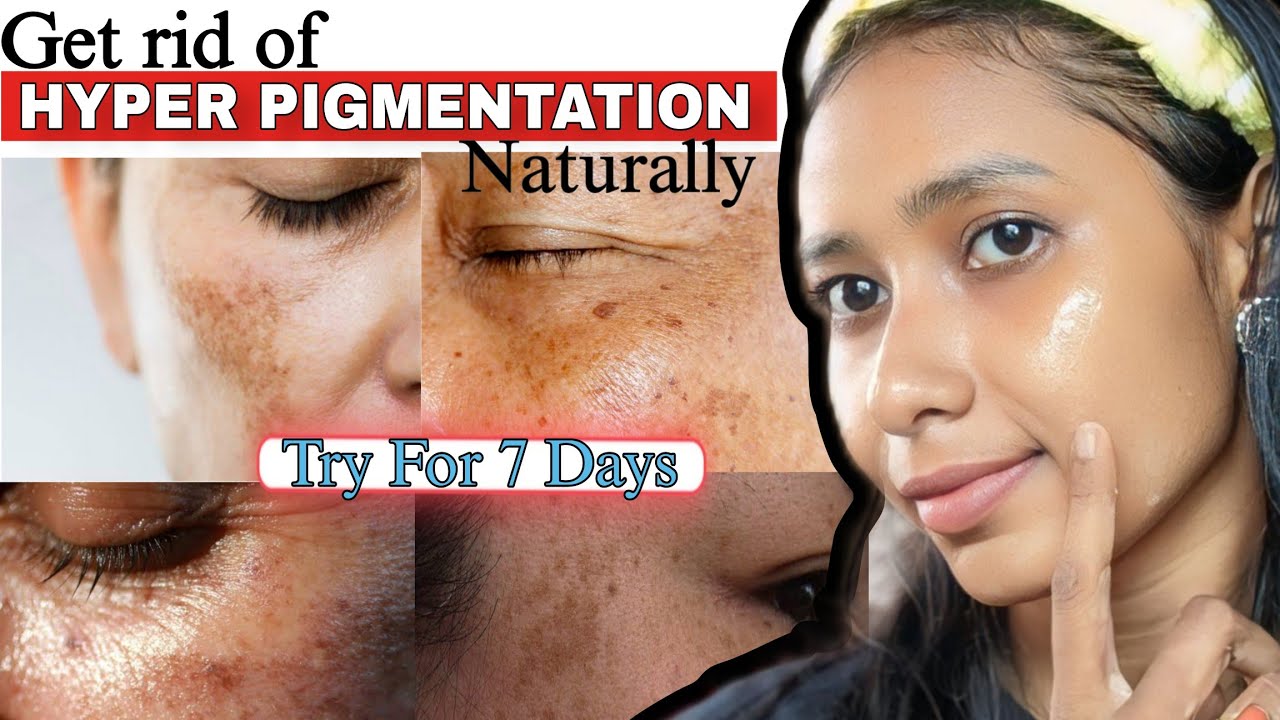Best DIY remedies for pigmentation and Dark spots | Treat DARK SPOTS at home🧴