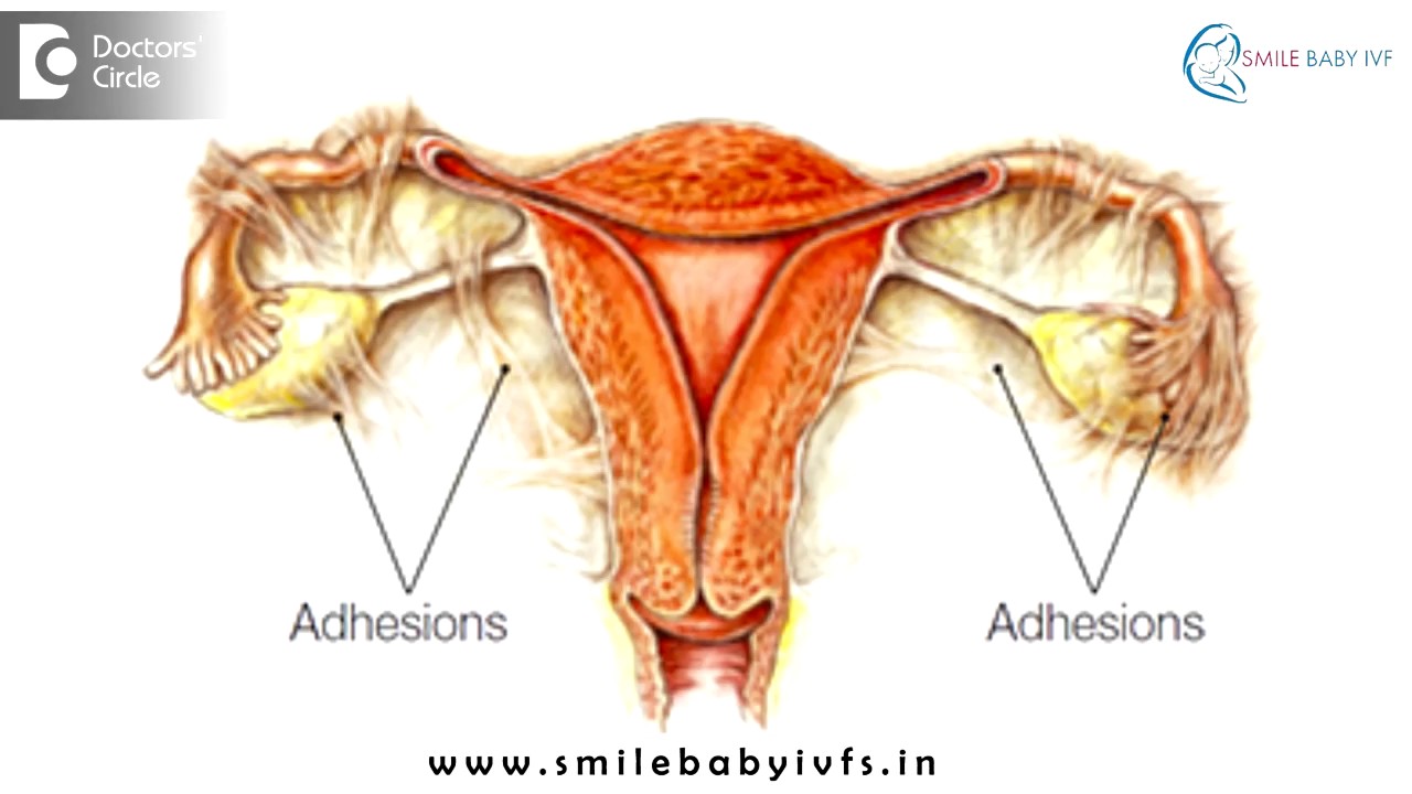 Causes of Fallopian Tube Blockage - Dr. Mangala Devi Bangalore | Fallopian Tube Recanalization india