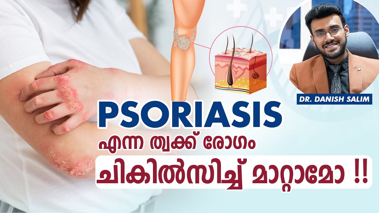 2257: തൊലി പൊളിഞ്ഞിളകുന്നുണ്ടോ, ചുവപ്പുള്ള പാടുകൾ കാണുന്നുണ്ടോ? | The truth about Psoriasis