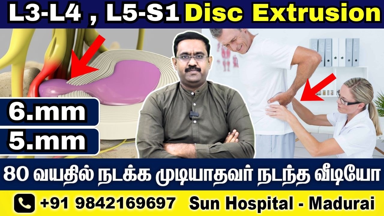 80 வயதில் நடக்க முடியாத முதுகு வலி | L3-L4 & L5-S1 Disc Extrusion Recovery | Sun Physio Hospital