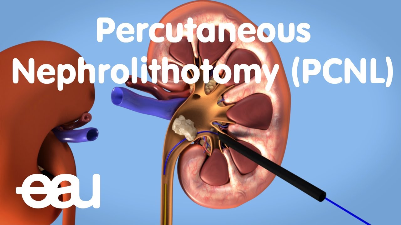 Removal of kidney stones: PCNL