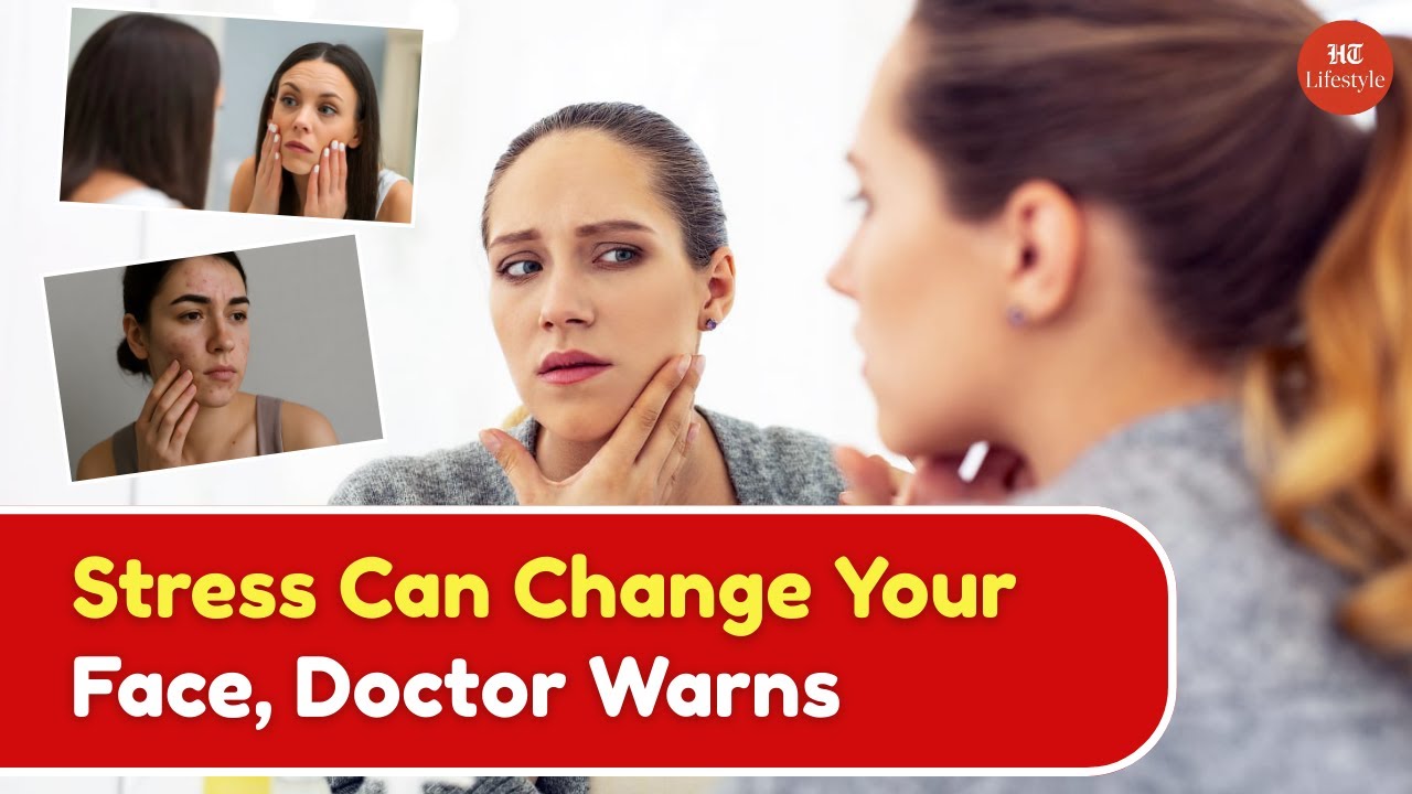 Stress Can Change Your Face: Doctor Explains Cortisol Face