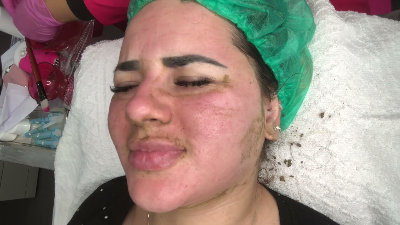 Peeling do Mar Morto 3 - passo a passo do procedimento - 2021