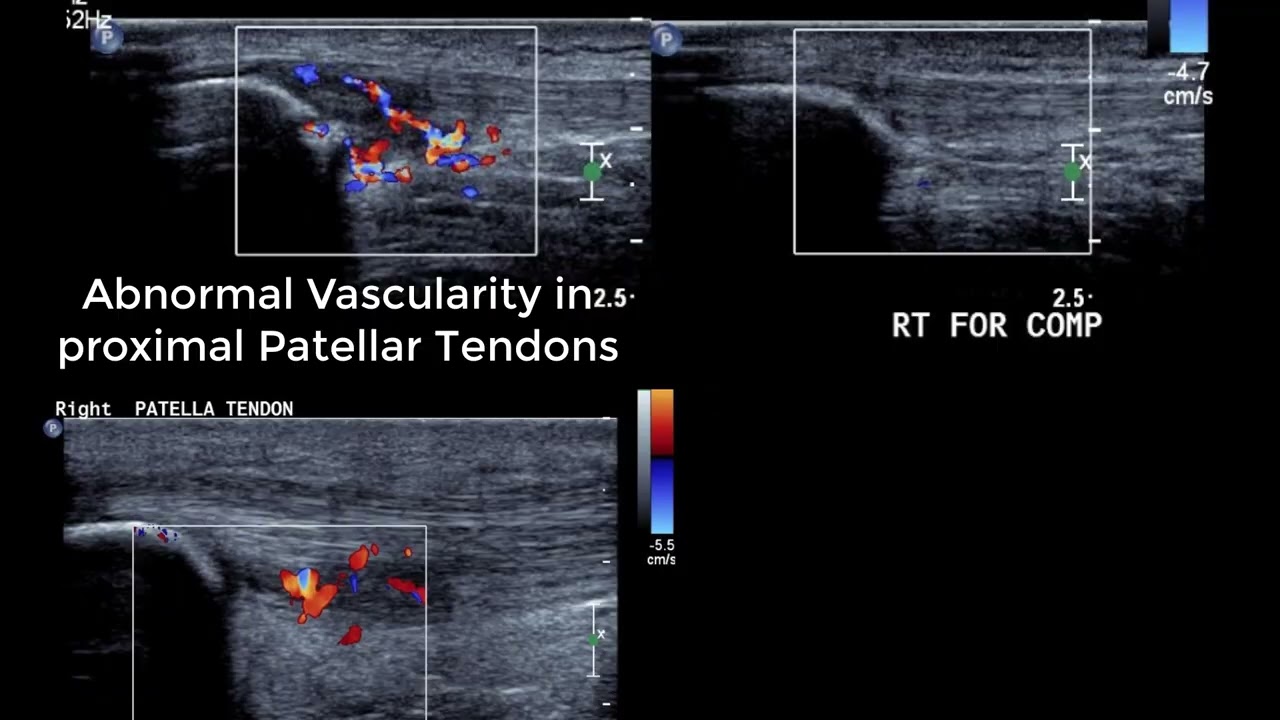 Knee Ultrasound basics - dynamic tests for anterior knee and ITB & identifying collateral ligaments