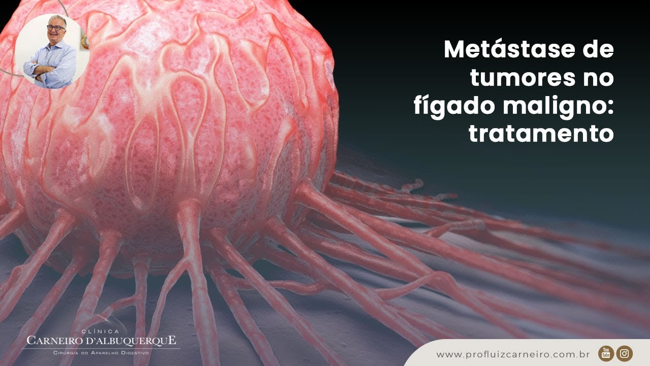 Metástase de tumores no fígado maligno: tratamento | Prof. Dr. Luiz Carneiro CRM 22761