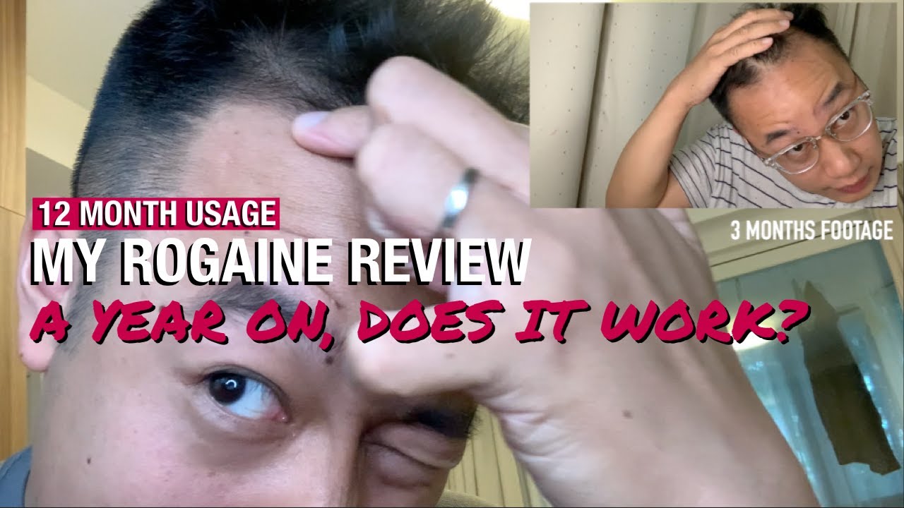 MY ROGAINE REVIEW: 12 Months Usage, does it work?