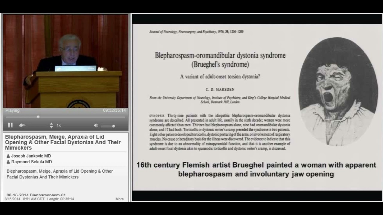 Blepharospasm, Meige, Apraxia of Lid Opening & Other Facial Dystonias and Their Mimickers