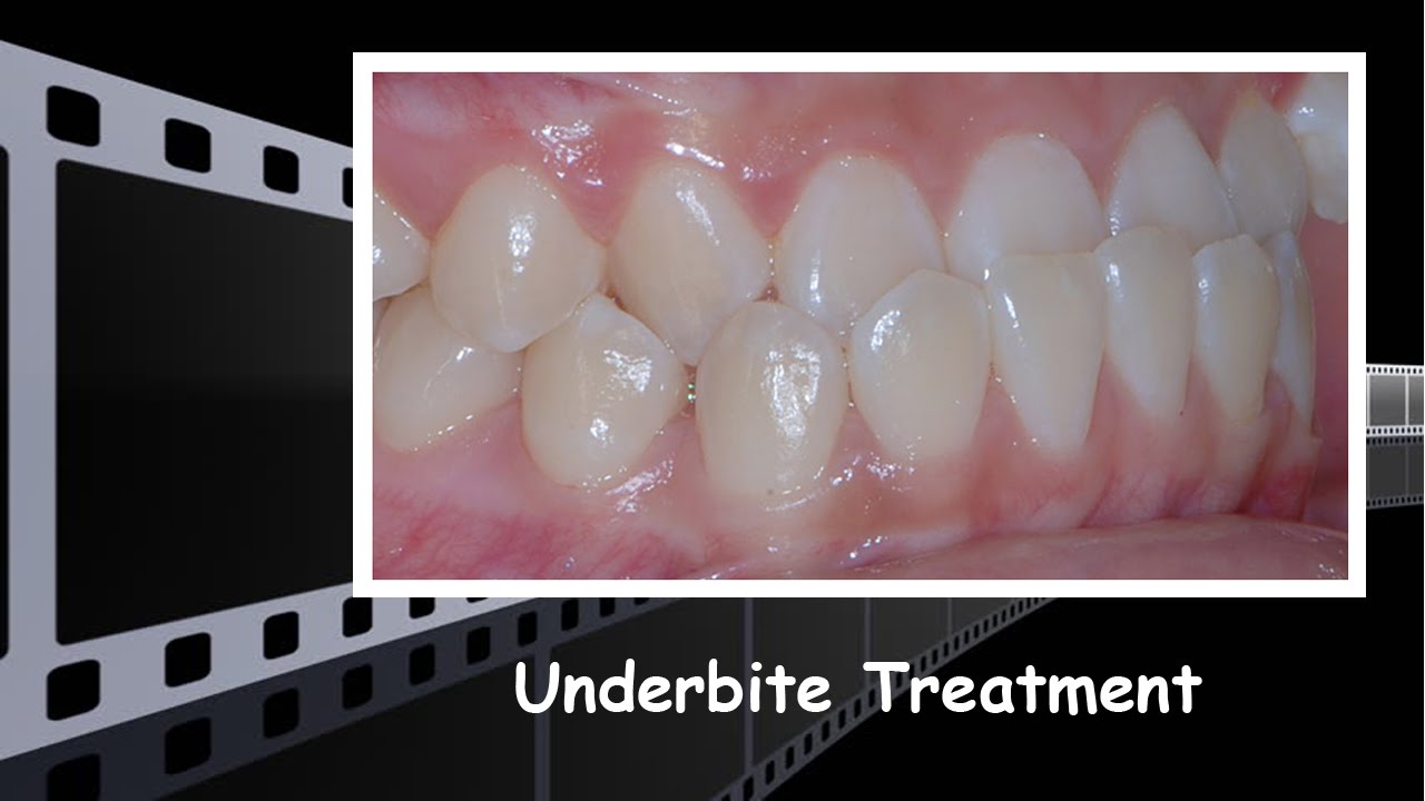 Underbite Treatment