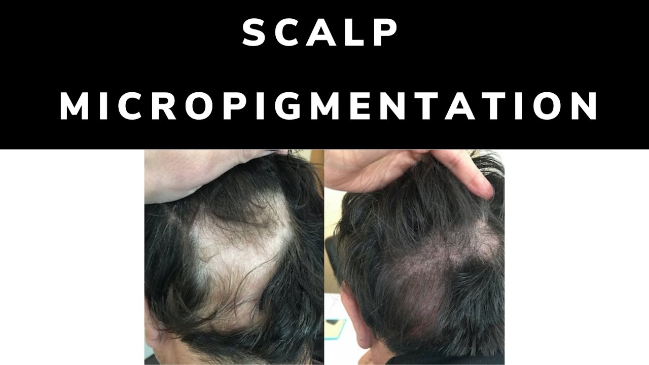 SCALP MICROPIGMENTATION QUESTIONS ANSWERED WITH DR. PARSA MOHEBI