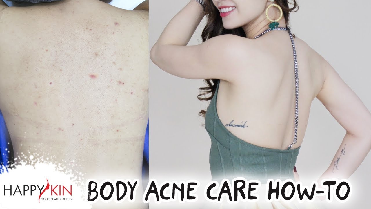 Cách Trị Mụn Lưng & Mụn Cơ Thể Triệt Để Tại Nhà | Happy Skin