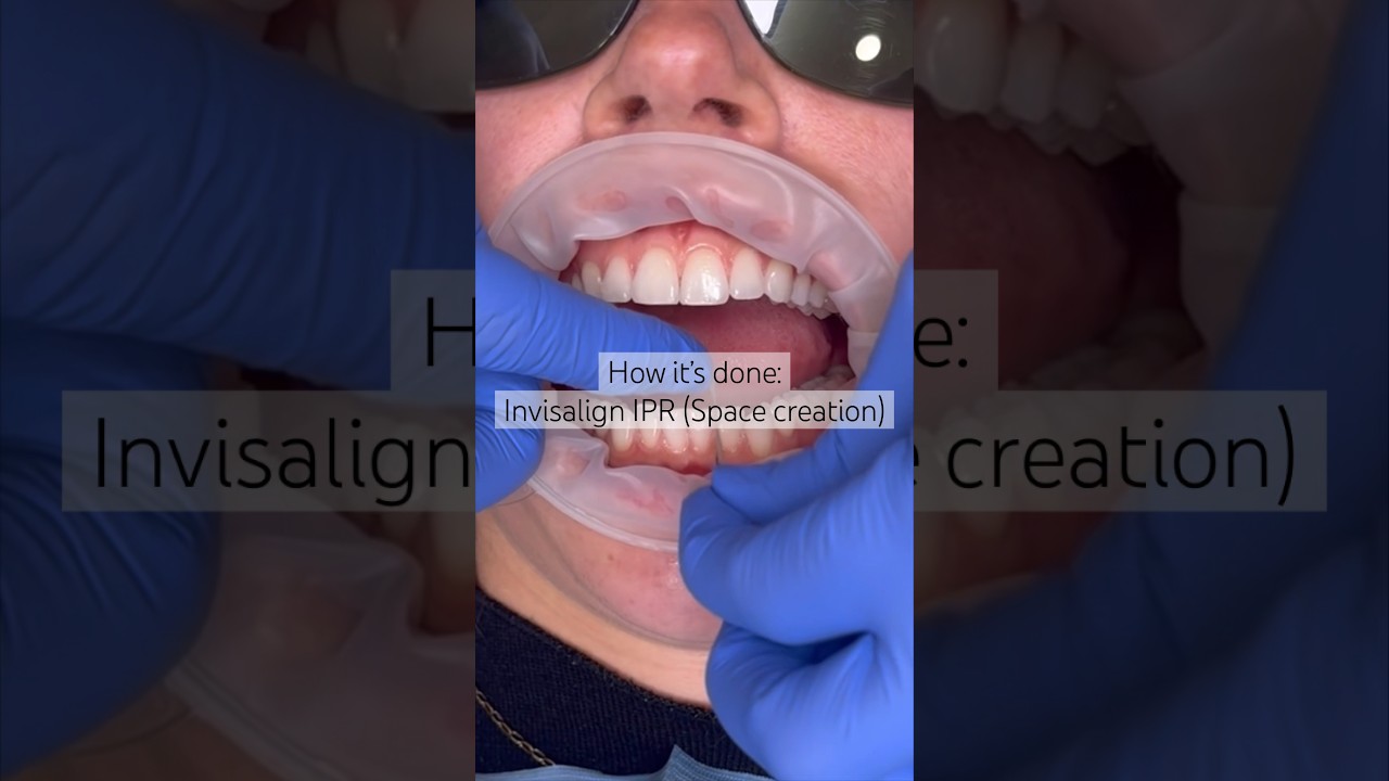 IPR is not as scary as it sounds! It’s quick, pain free and the gaps are very small 🙌 #