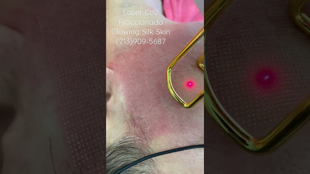 Laser Co2 Fraccionado piel de Porcelana (213)909-5687 Los &Aacute;ngeles