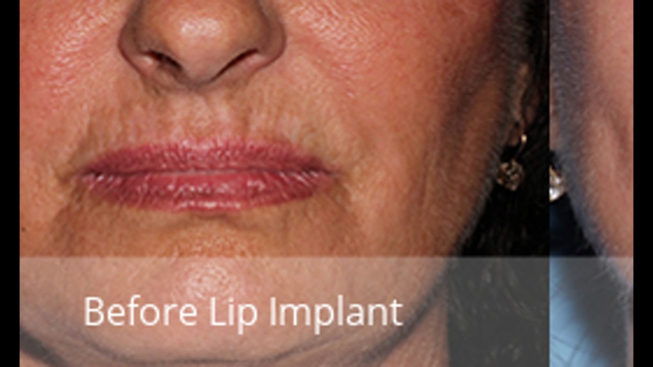 Lip Implant