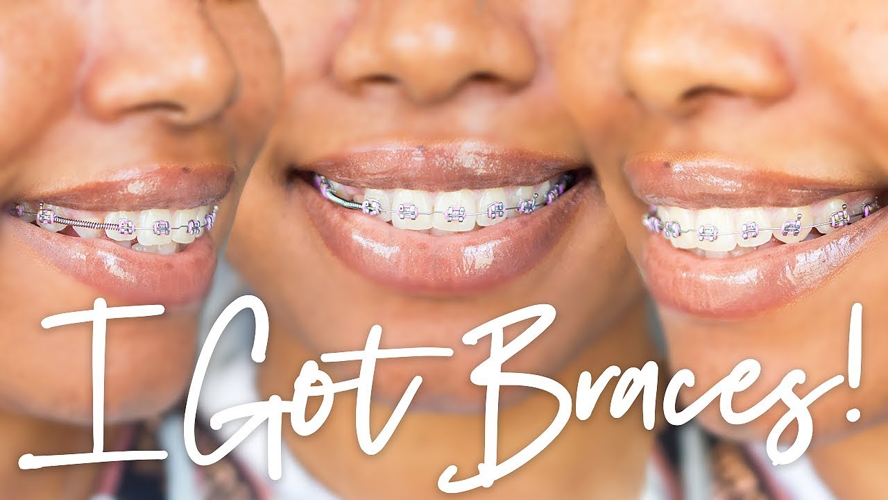 I GOT BRACES!!!