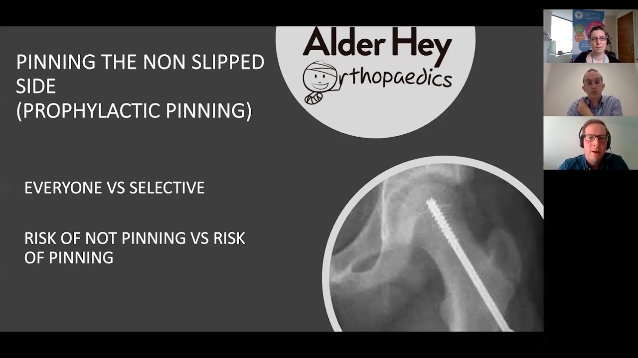 Slipped Capital Femoral Epiphysis or Slipped Upper Femoral Epiphysis, also know as SCFE or SUFE