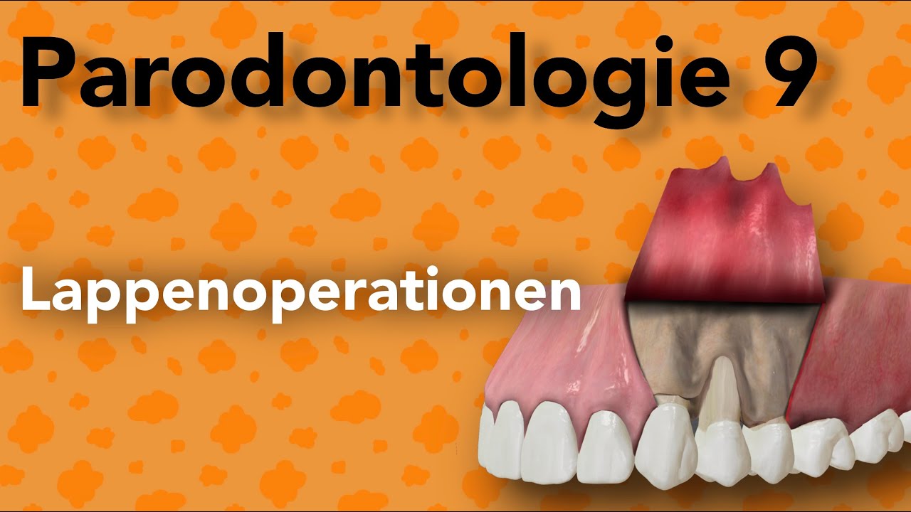 Parodontologie 9 -  Lappenoperationen