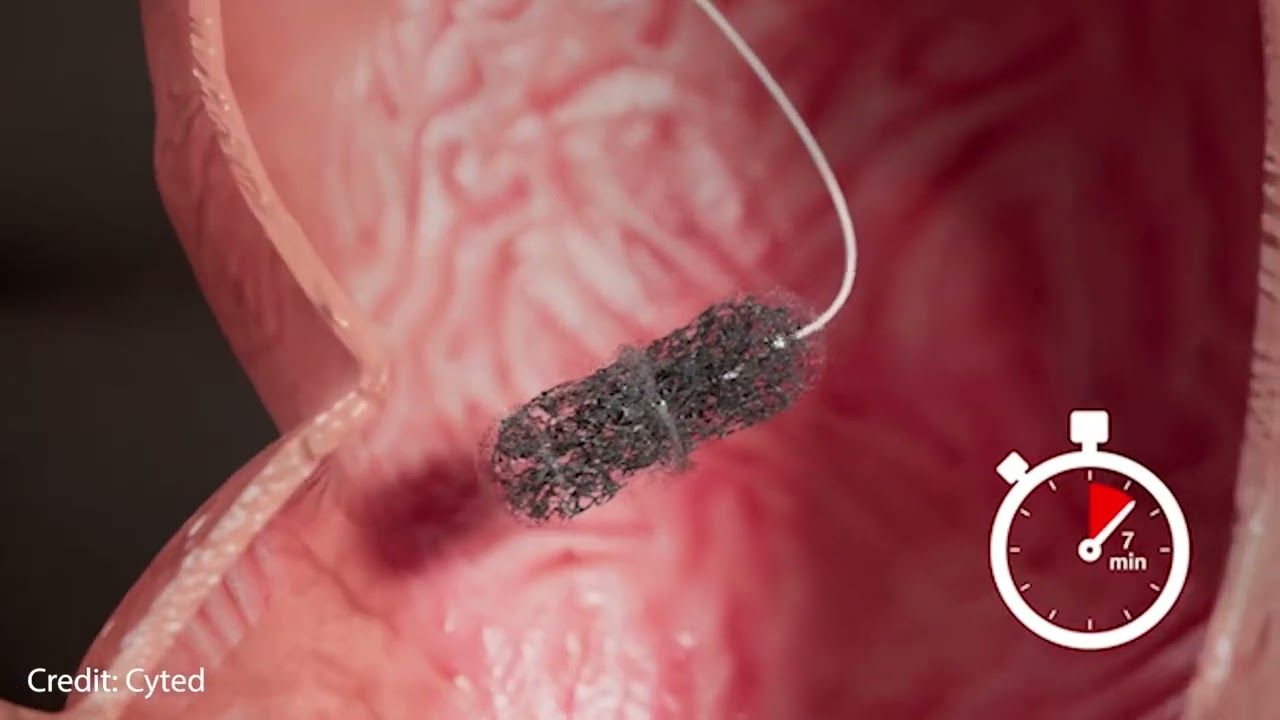 Capsule Sponge test, explained by Irene Debriam-Beecham, Senior research nurse at CUH