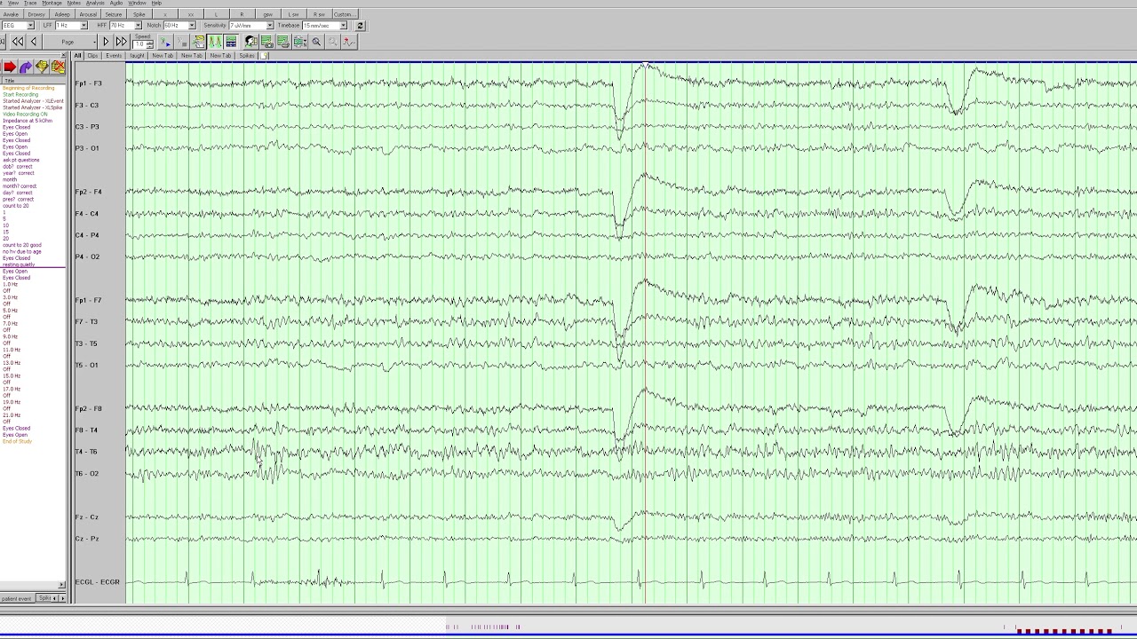 Breach rhythm