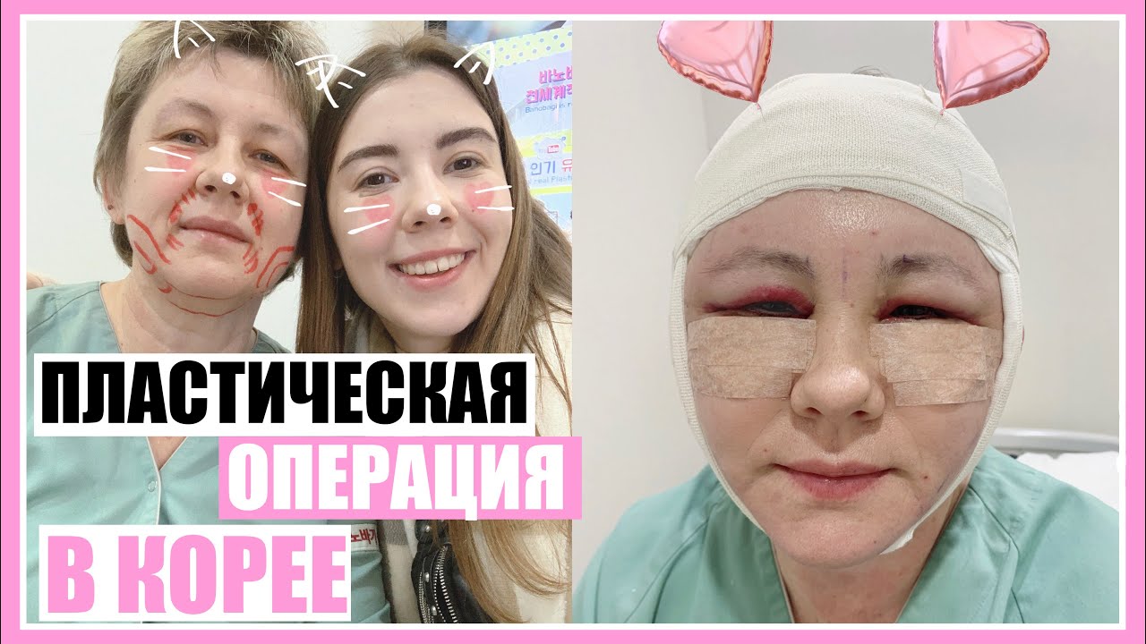 ВО ВРЕМЯ И ПОСЛЕ ПЛАСТИЧЕСКОЙ ОПЕРАЦИИ 🤒🏩 ЖИЗНЬ В КОРЕЕ НАША ИСТОРИЯ 🇰🇷 СЕУЛ 💖