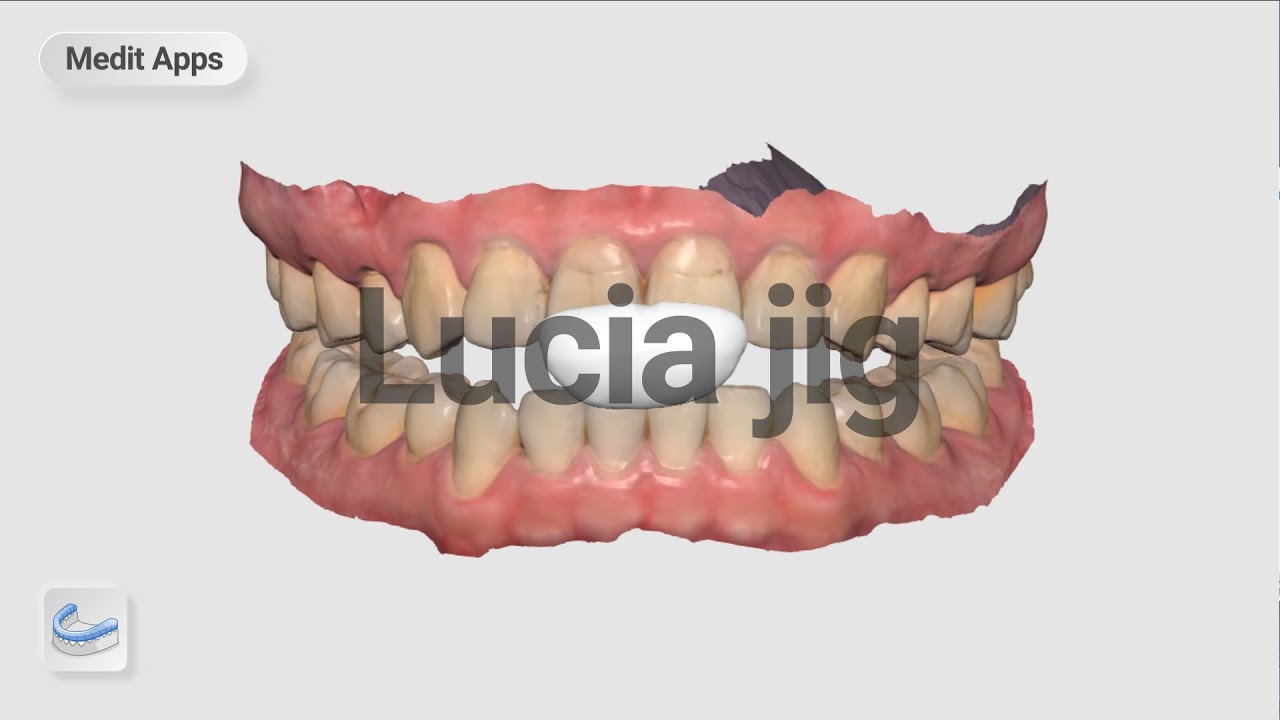 Designing a Lucia Jig with Medit Splints App
