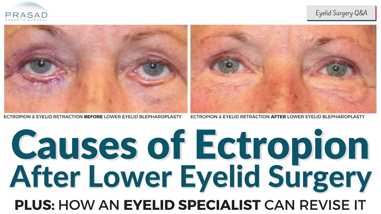 Causes of Ectropion after Lower Eyelid Surgery, and Possible Restoration by an Eyelid Specialist