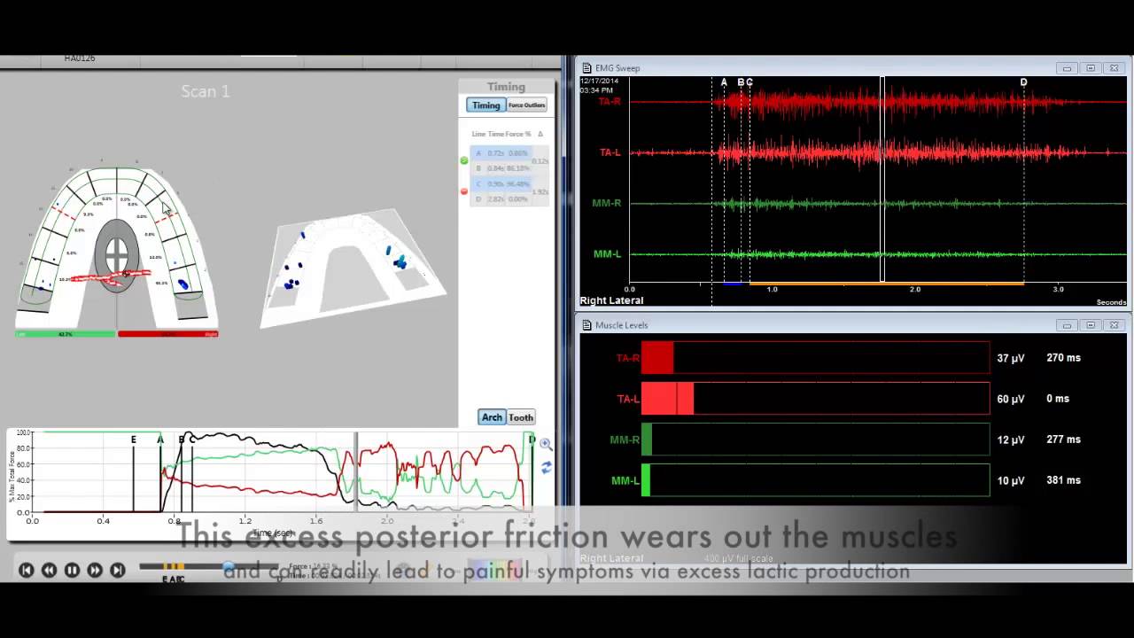 CHRONIC disk displacement WITHOUT REDUCTION-when NOT to DTR!