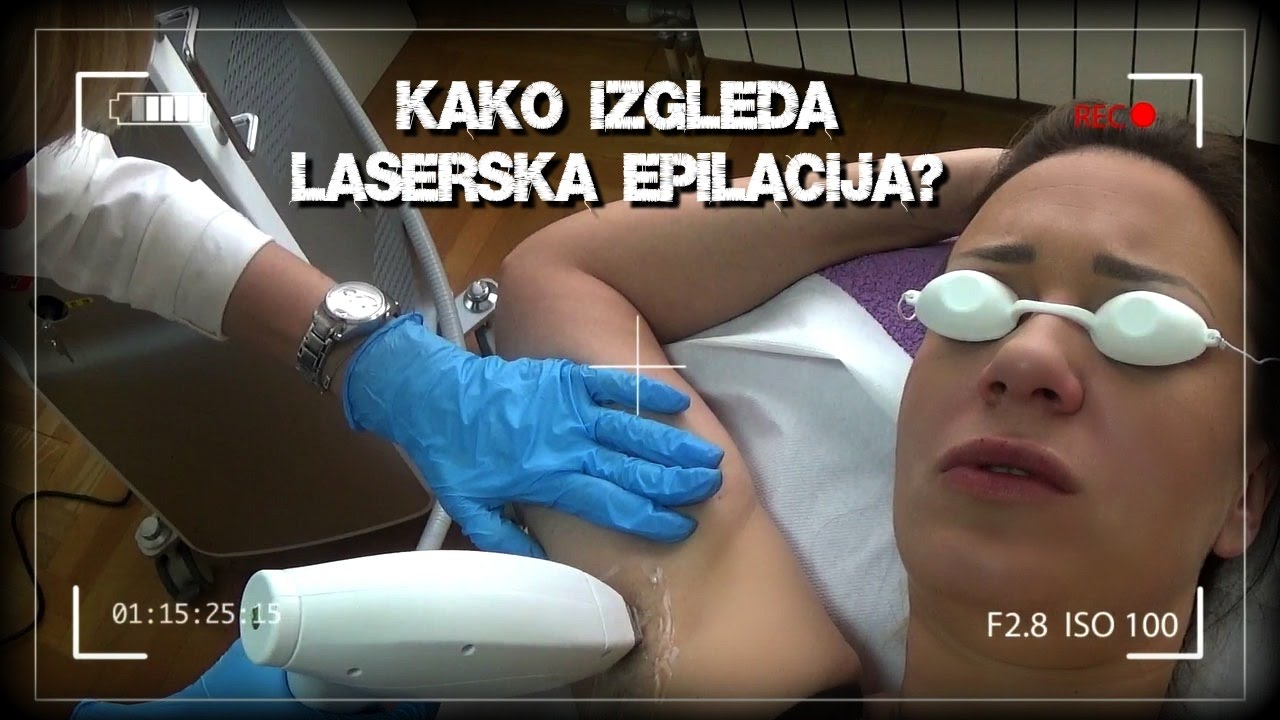 Laserska epilacija: prvi tretman i utisci!