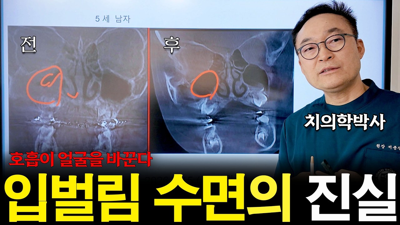 어린이 코골이가 위험한 이유｜아데노이드형 얼굴
