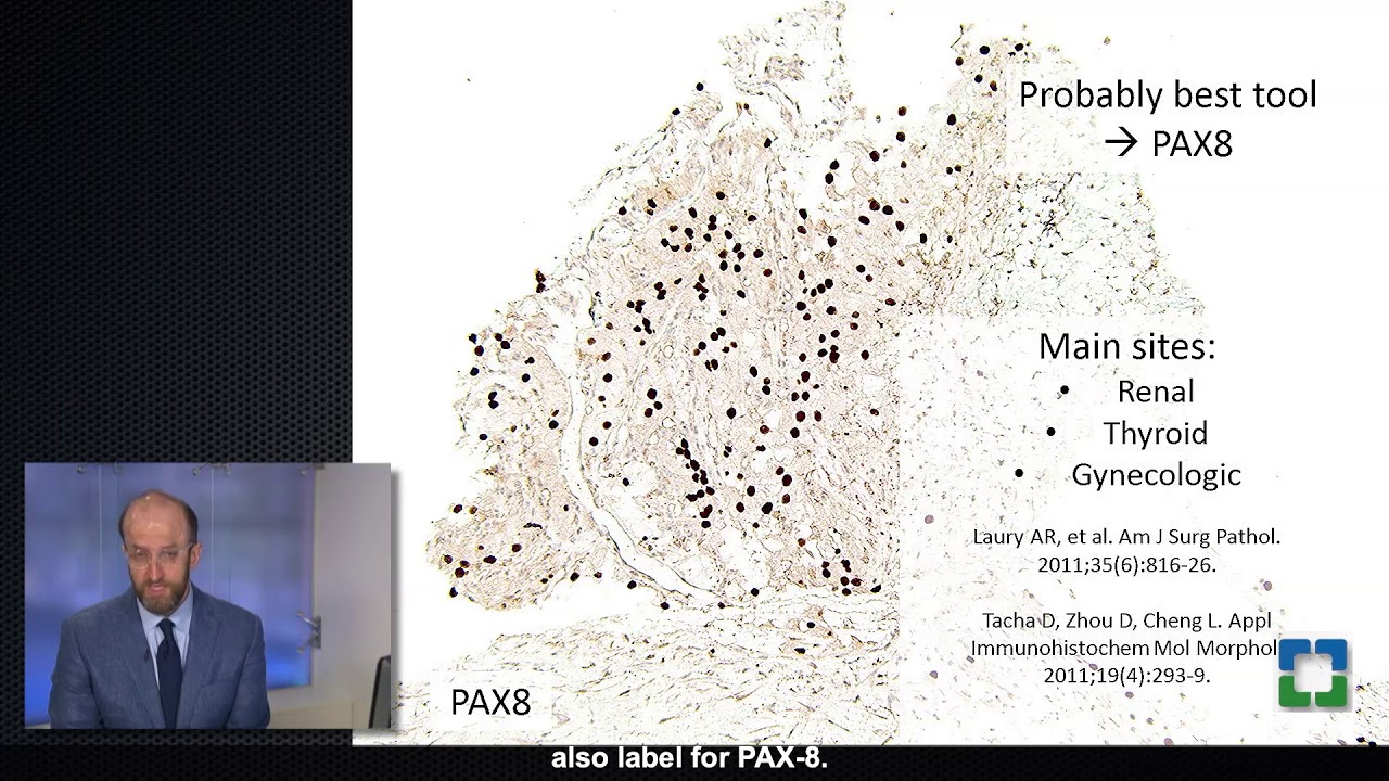 Diagnosis of Metastatic Renal Cancer with Sean Williamson, MD