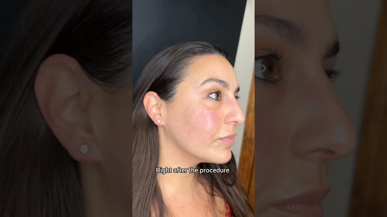 Sofwave is the future of skin tightening ✨️ #newyork #skincare  #manhattan