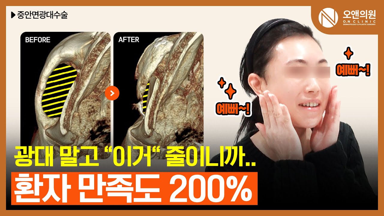 광대 말고 '이거' 줄이니까 환자 만족도 200% | (JPN/CN/ENG SUB) #윤곽 #중안면축소술 #광대비대칭 #성형