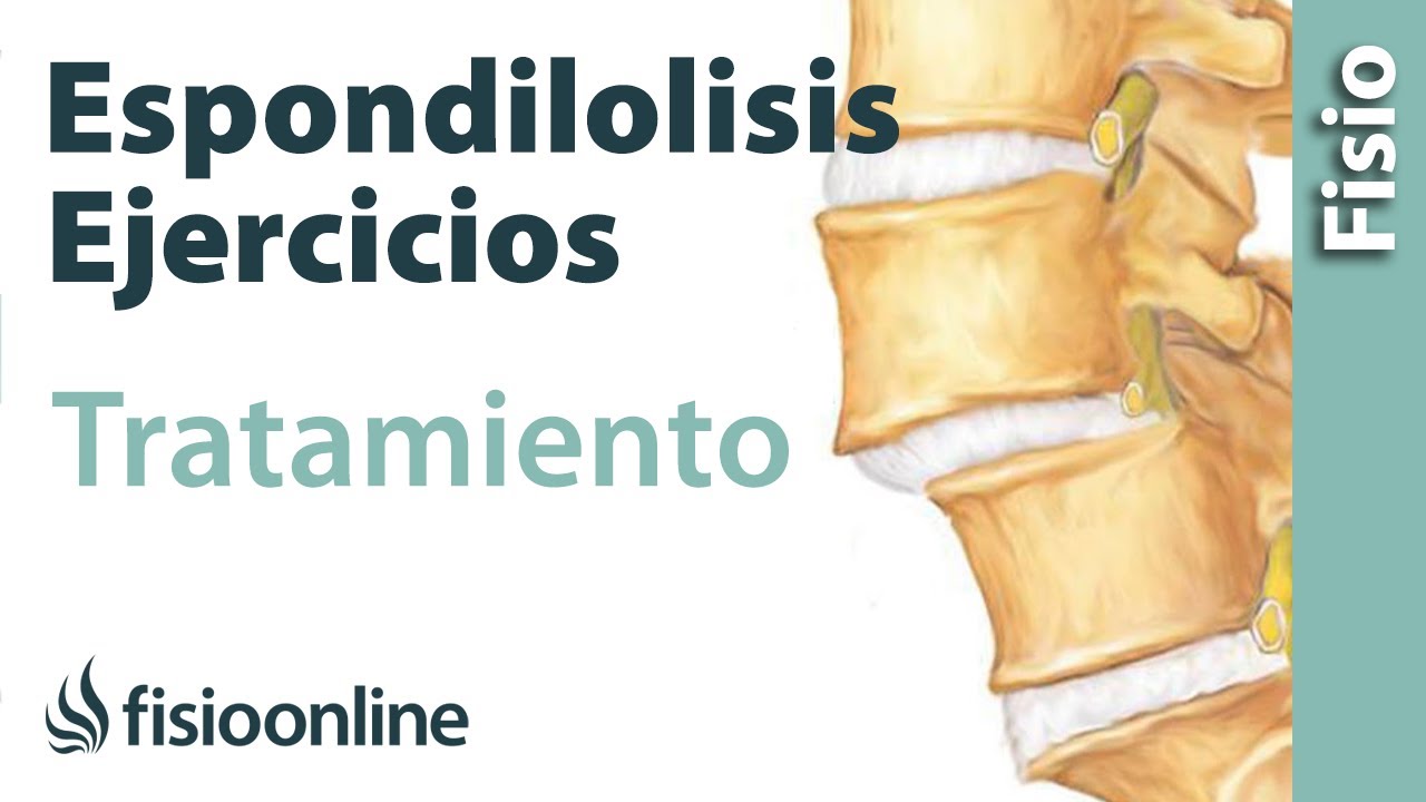 Espondilolisis y espondilolistesis - Tratamiento con ejercicios, automasajes y estiramientos