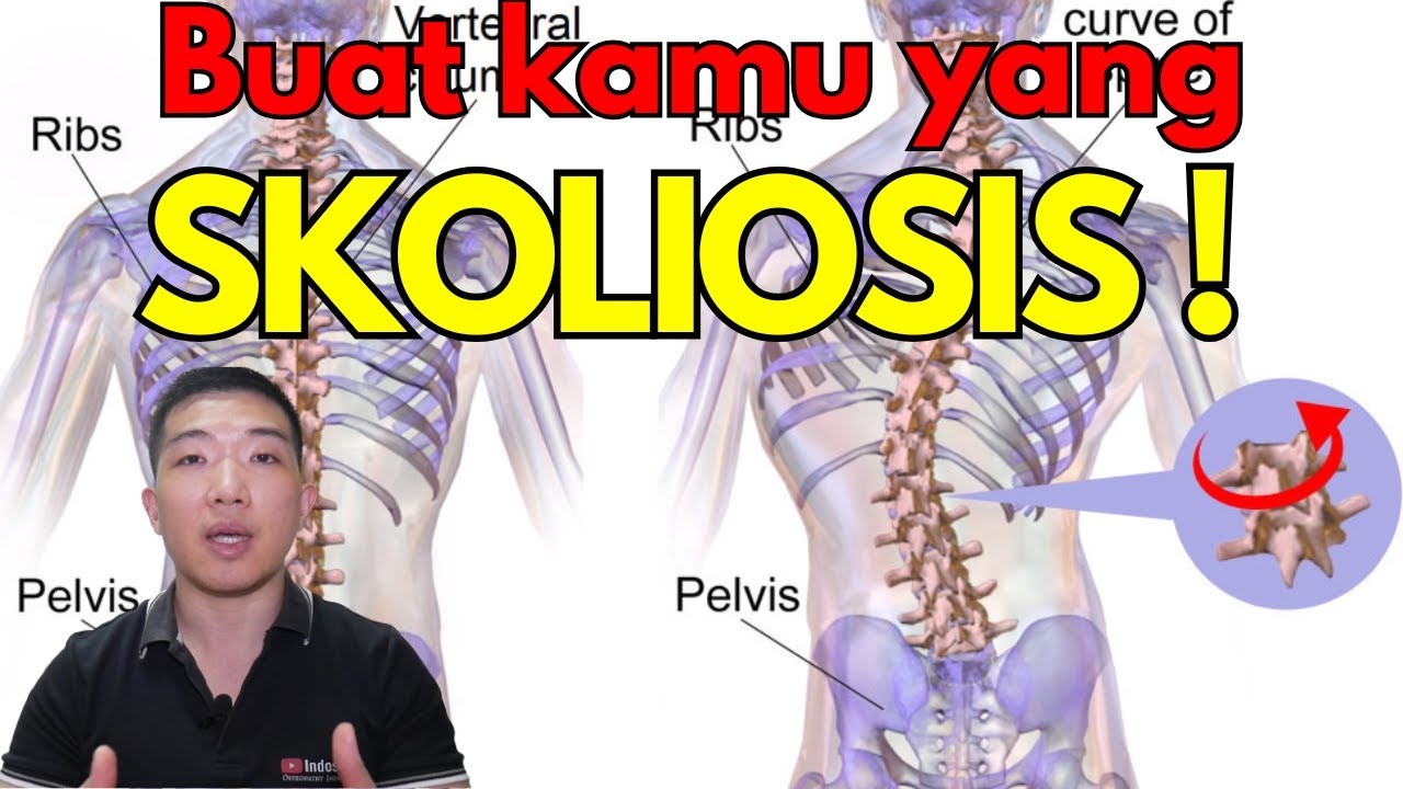 4 hal yang PENTING buat SKOLIOSIS !