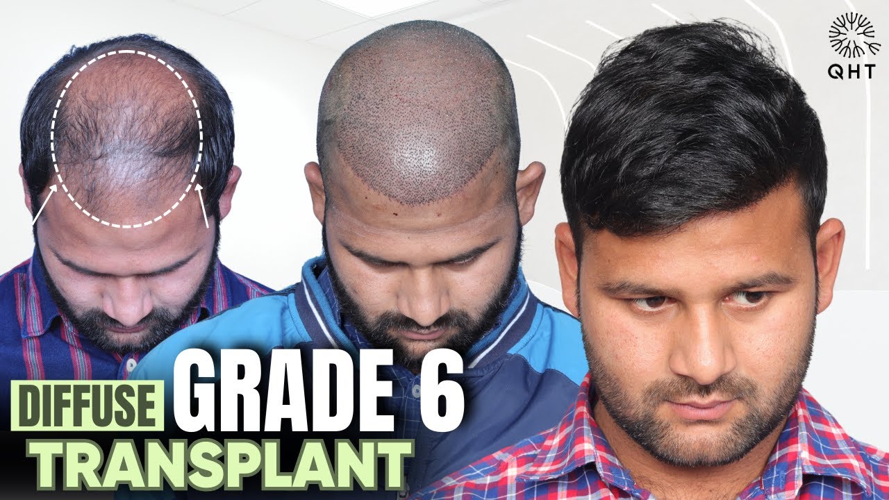 Grade 6 Hair Loss | Grade 6 Hair Transplant | Grade 6 Baldness Transplant | Grade 6 | QHT Clinic