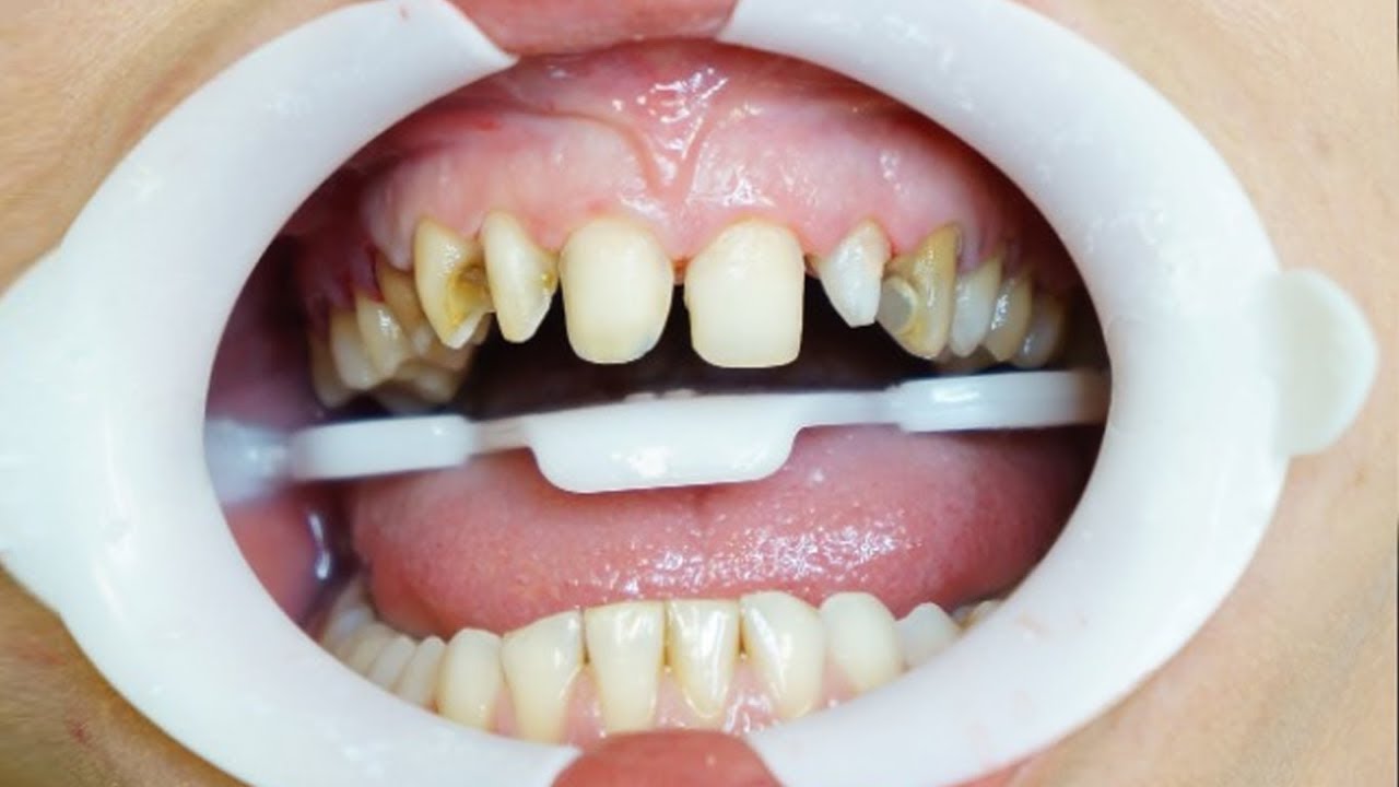 TROQUEI OS DENTES DA MINHA MÃE | LENTES DE CONTATO DENTAL